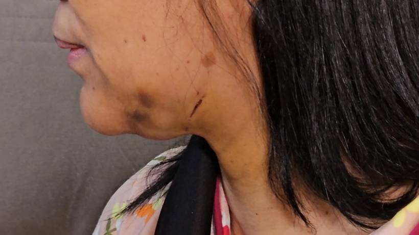 Costureira é salva por cachecol em acidente com fio solto em rua de Pouso Alegre
