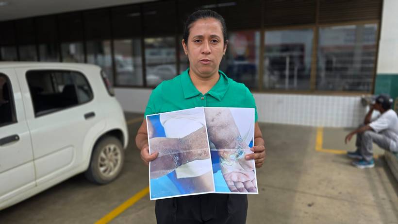Família aponta negligência de hospital após criança ficar com feridas em braço engessado